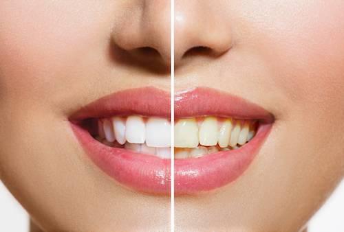 Why professional teeth whitening treatment is the best way to get rid of stained teeth?